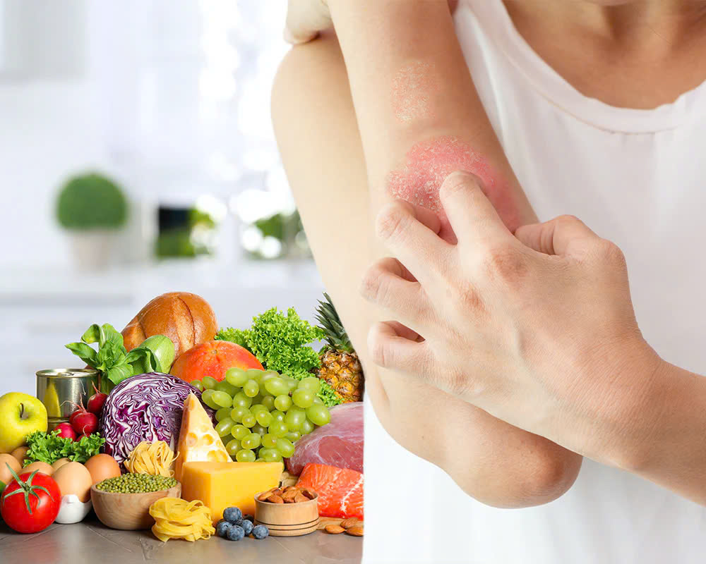 Kiểm soát bền vững bệnh vảy nến bằng thuốc nam và lối sống khoa học | Dược Thảo Linh - Khoa học thảo dược
